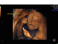 Cleft lip 3D